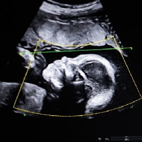 Ultrasound image of a human fetus in the third trimester