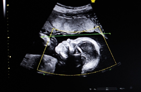 Ultrasound image of a human fetus in the third trimester